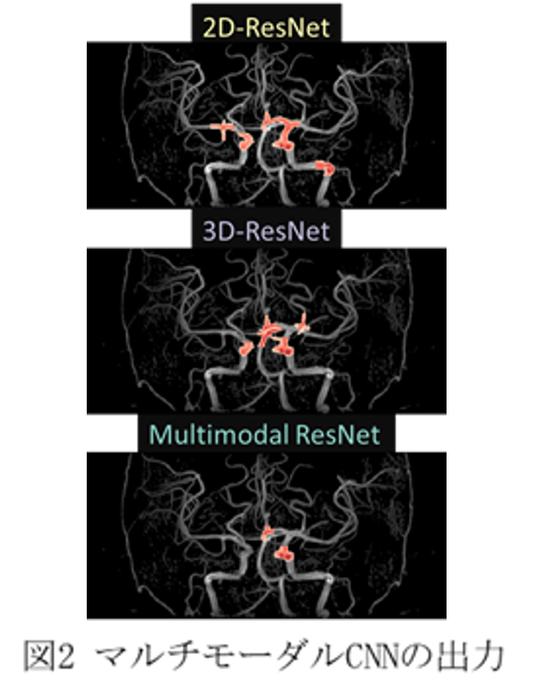 	ディープラーニングによる脳動脈瘤の高精度自動抽出2