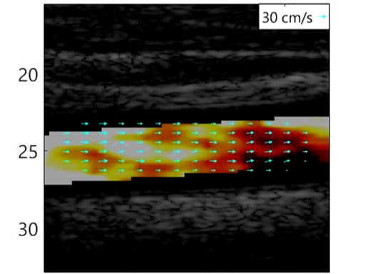 ヒト頸動脈内血液の流速・散乱体径評価ベクトルマップ