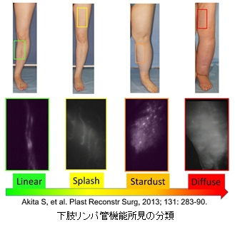 下肢リンパ管機能初見の分類