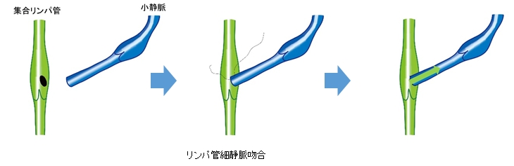 リンパ管細静脈吻合術