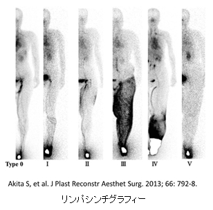 リンパ管シンチグラフィー